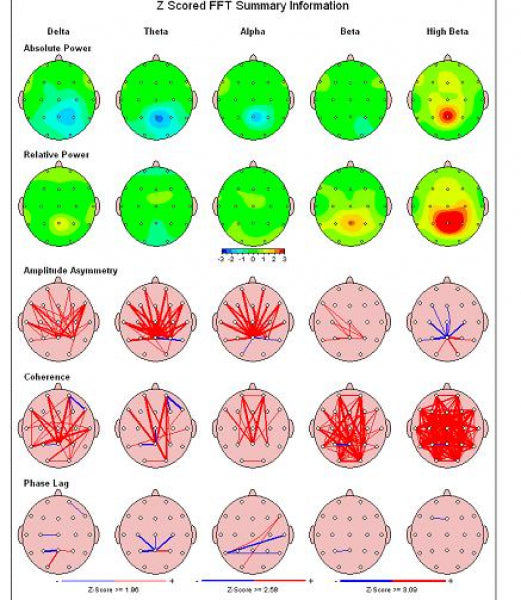 Discovery 24E EEG-Gerät 19 Kanal mit BrainAvatar 4.0 (mit integriertem Impedanzmesser)