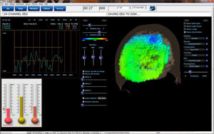qEEGPro sLORETA Z-Score Training 19 Channels (Volumen)