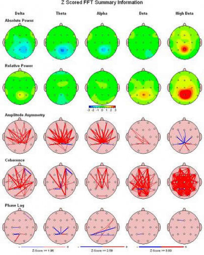 NeuroGuide | Professionelle QEEG-Analyse & Brain Mapping