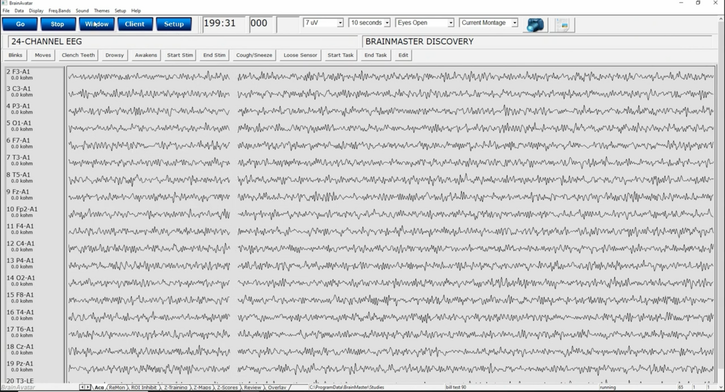 BrainAvatar ™ 4.0 Discovery Acquisition