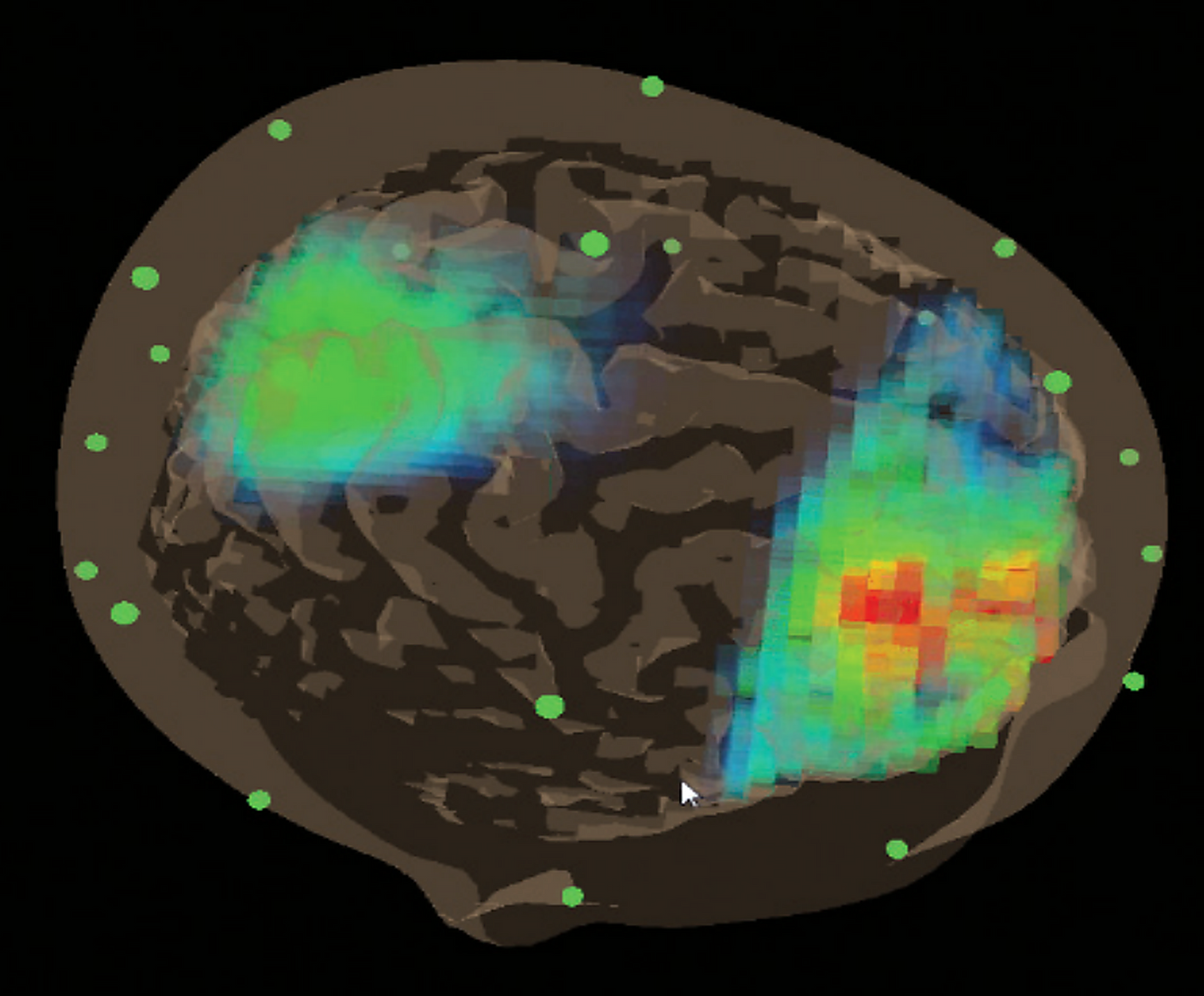 BrainAvatar ™ 4.0 - Discovery Analysis