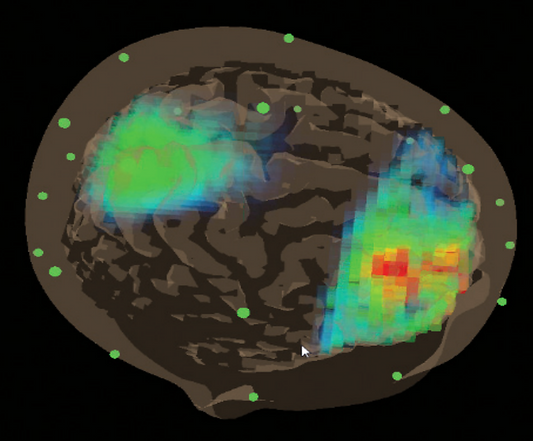 BrainAvatar ™ 4.0 - Discovery Analysis